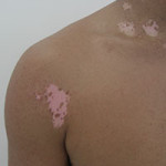 vitiligo BH