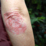 psoriase puva