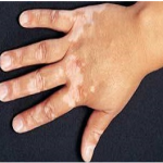 Vitiligo
