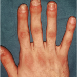 artrite psoriasica 1