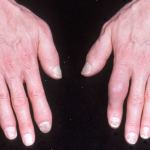 artrite psoriasica3