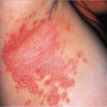 psoriase invertida